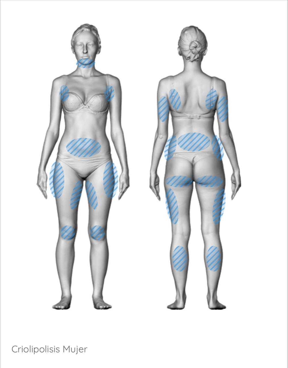 Criolipólisis abdomen y pectorales