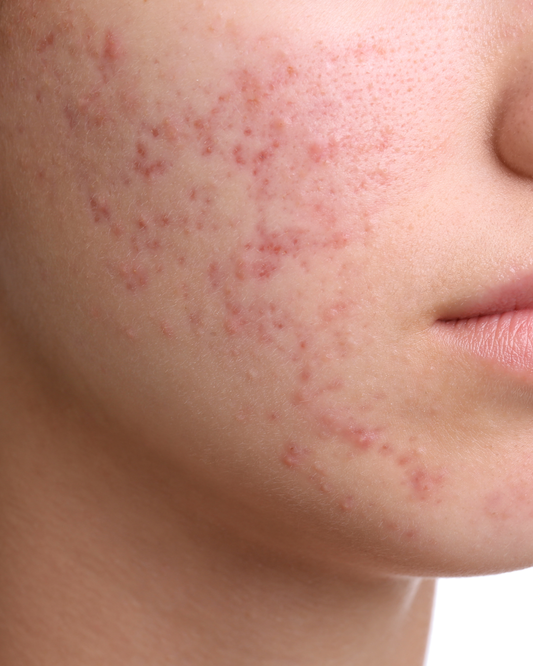 Tratamiento Acné