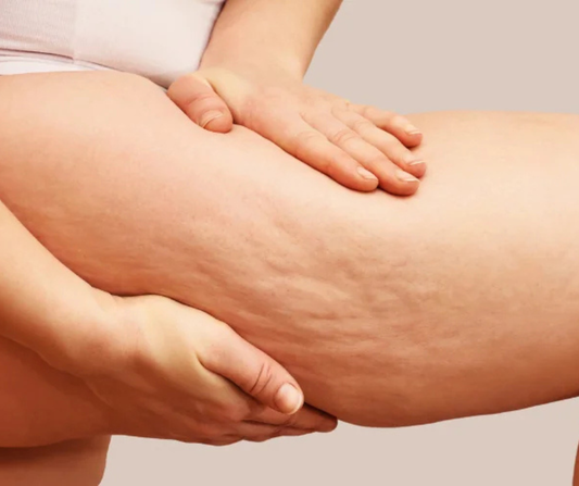 Tratamiento Lipedema: Pack 1 Zona