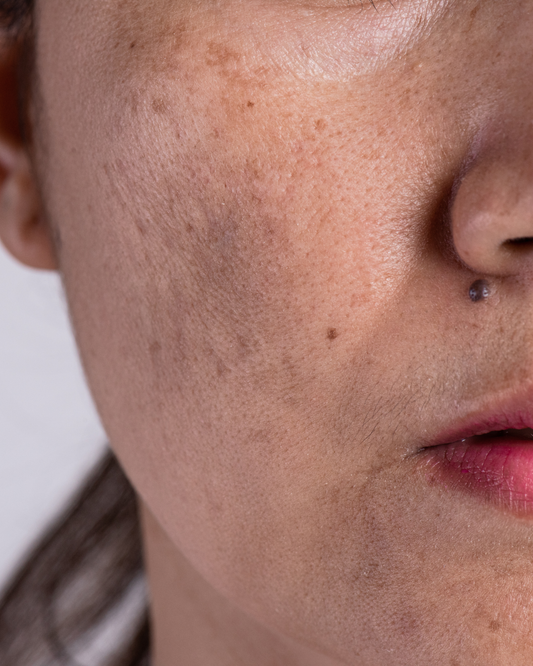 Tratamiento Despigmentante de Rostro