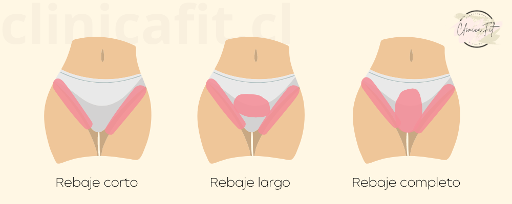 Depilación láser: glúteos, línea interglútea y rebaje completo